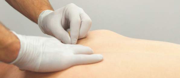 Dry Needling PTSMC physical therapy