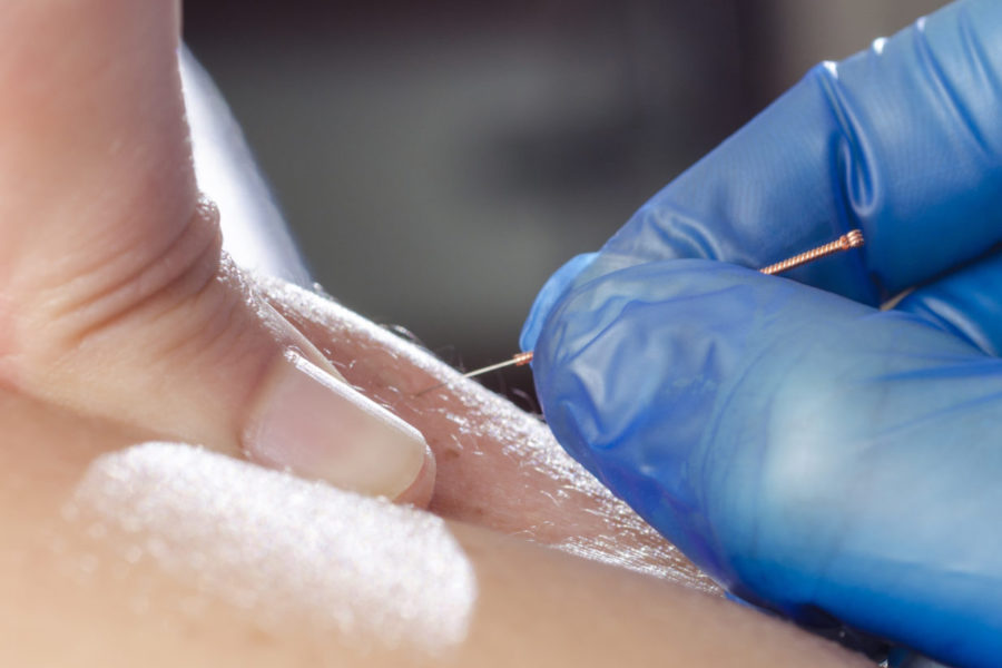 PTSMC dry needling physical therapy