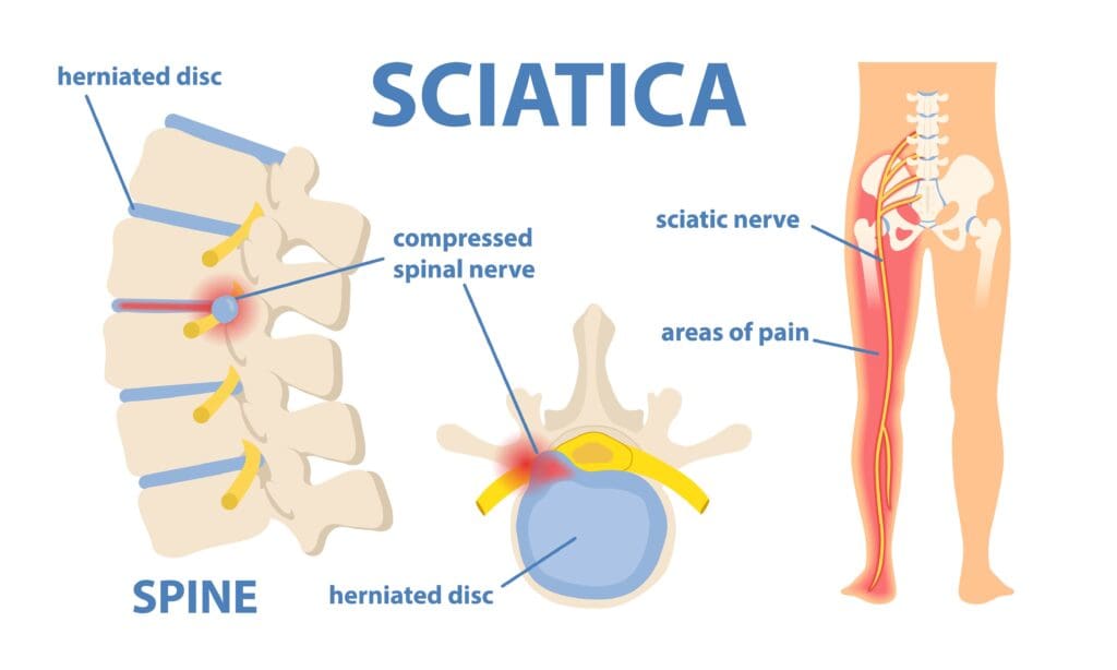 anatomical diagram of sciatica and sciatic nerve pain