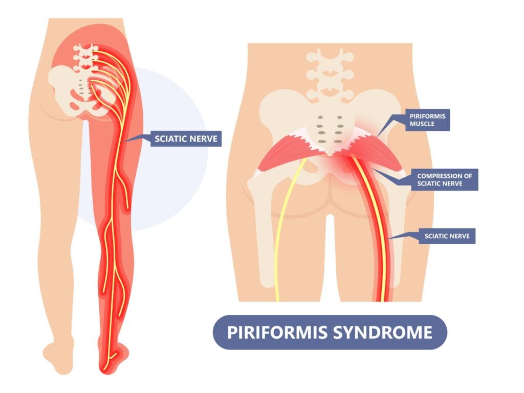 Graphic of piriformis syndrome and sciatic nerve
