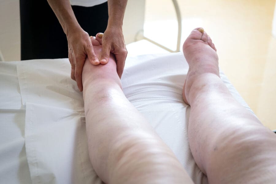 Physical therapist treating lymphedema