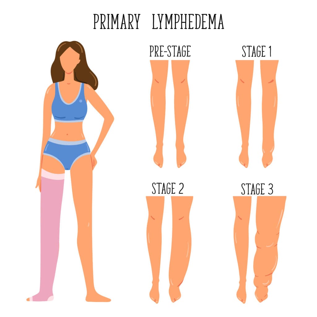 Primary Lymphedema stages. Lymphatic system disfunction. Elephantiasis, legs swelling disease. Young girl wearing compression stocking.