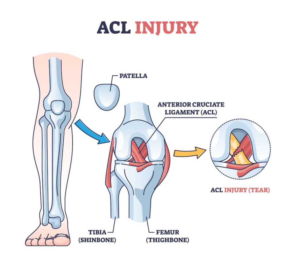 ACL injury or trauma as tear or sprain of anterior cruciate outline concept. Labeled educational leg or knee pain anatomical explanation with bone and ligament medical structure vector illustration.